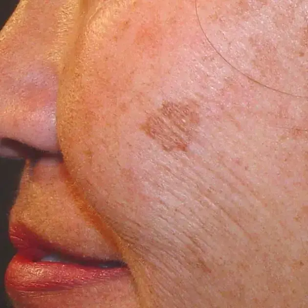 Queratosis y lentigos
