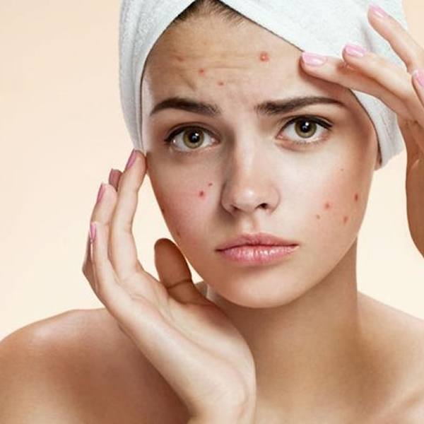 Manejo de acné y sus secuelas
