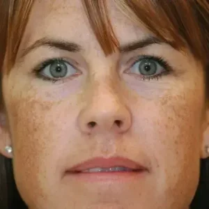 melasma2