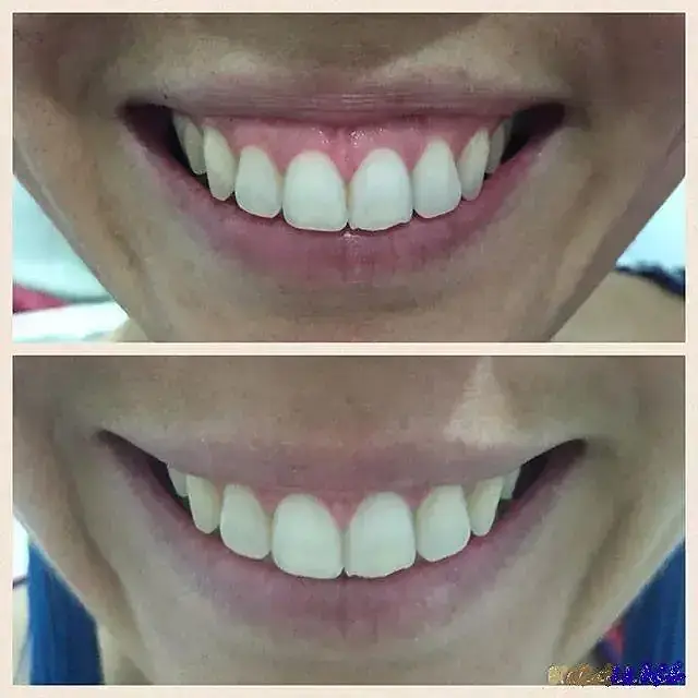 Sonrisa Gingival