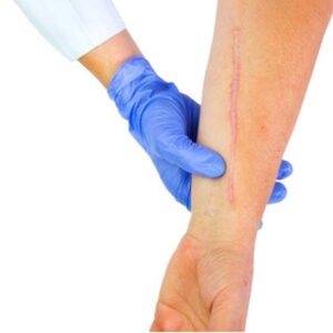 tratamientodecicatrices