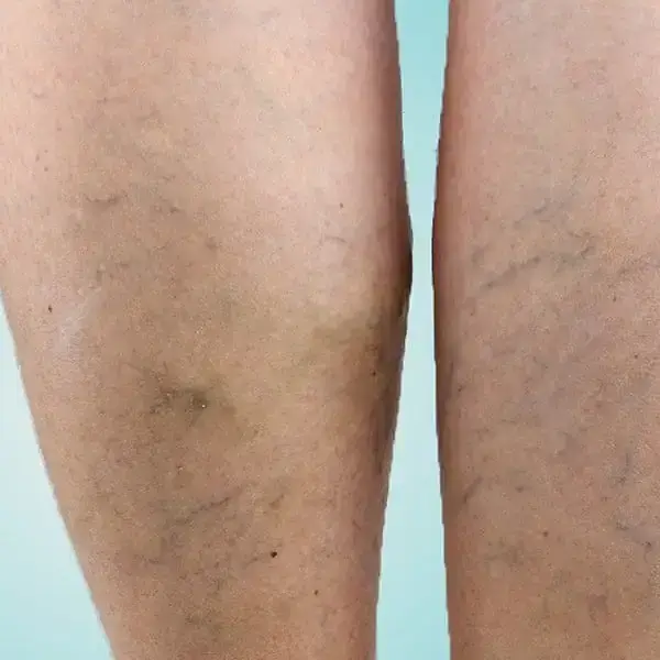 Tratamiento de vasitos