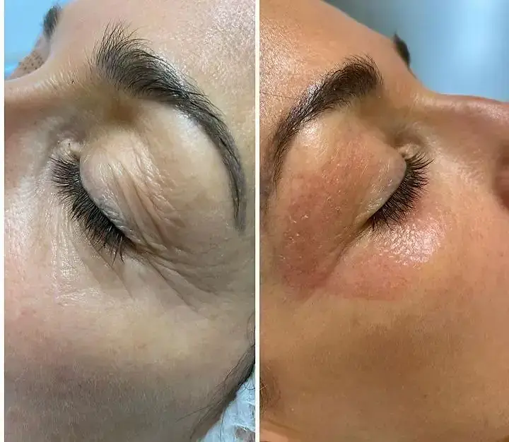 Estiramiento cutáneo con Fibroblasting